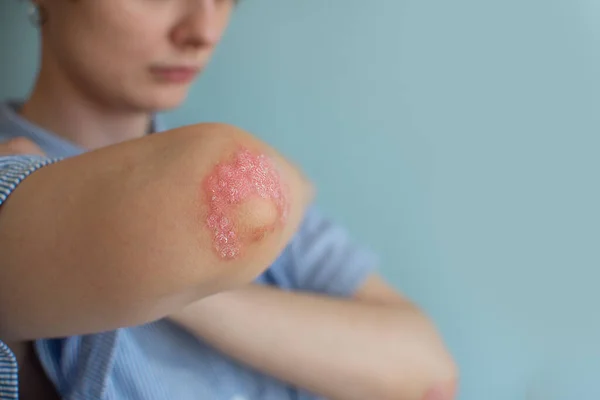 Žena s lupénkou. Zdravotní alergie kožní péče problém, Psoriasis vulgaris. kloubů postižených psoriatickou artritidou — Stock fotografie