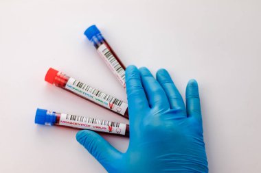 maymun çiçeği virüsü için kan testi yapılan mataralar pozitif ve negatif.