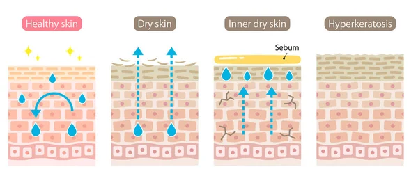一组皮肤类型 内干的 健康的和高角化的皮肤细胞层 健康美感肌肤护理概念 — 图库矢量图片