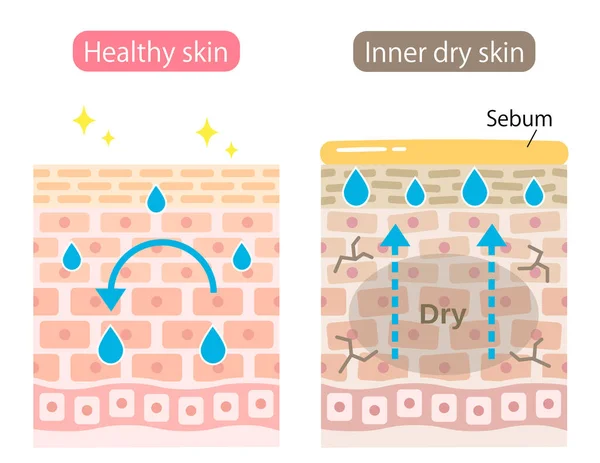 Vnitřní Suchá Zdravá Vrstva Kožních Buněk Pokožka Produkovat Extra Mazu — Stockový vektor