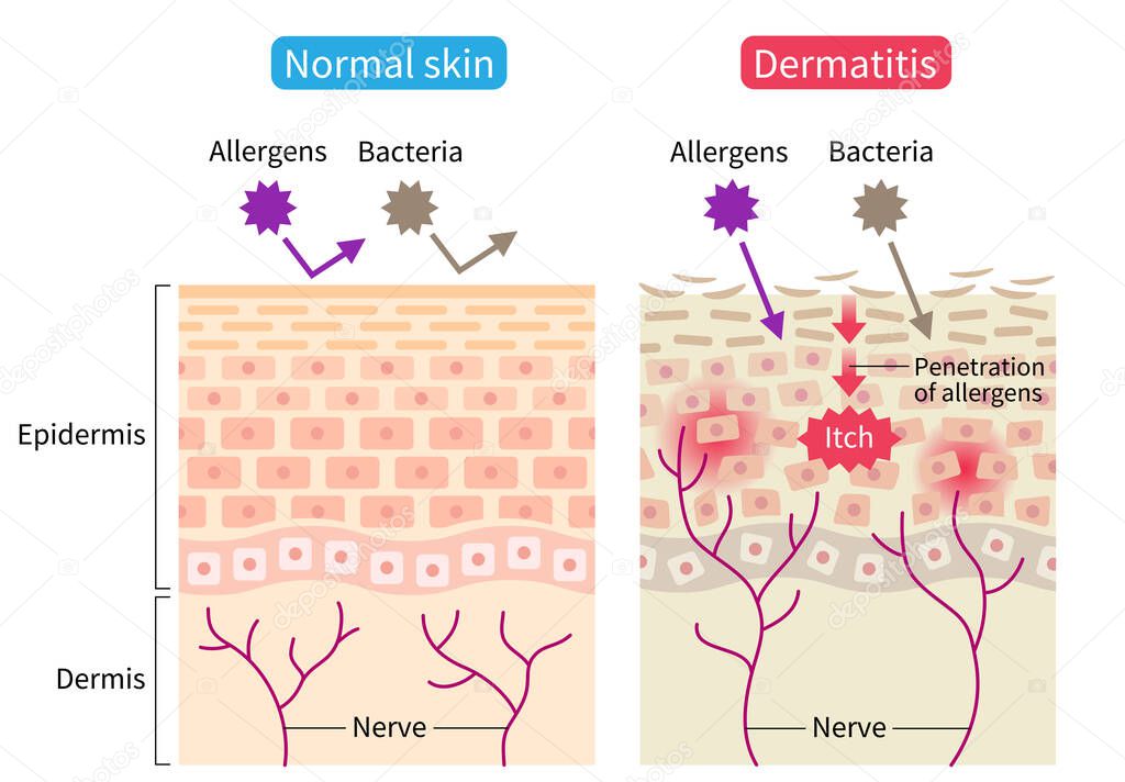 atopic dermatitis (eczema) and normal skin cell illustration. Healthy skin care concept