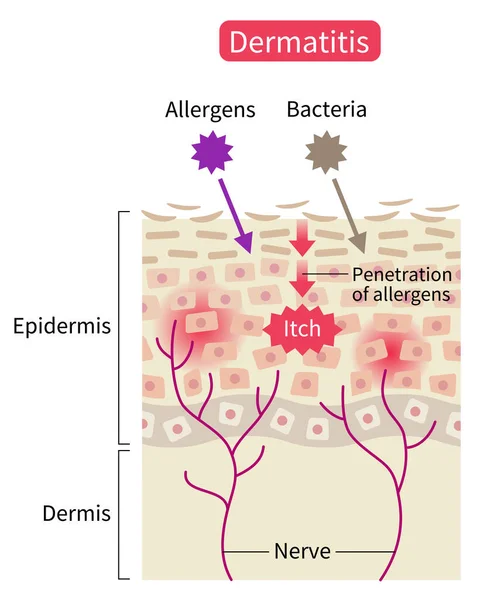 Atopic Dermatitis Eczema Skin Disrupt Moisture Barrier Allows Penetrate External — Vector de stock