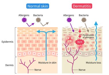 atopic dermatitis (eczema) and normal skin cell illustration. Healthy skin care concept