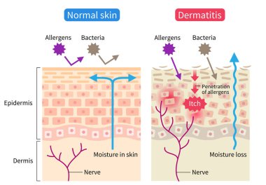 atopic dermatitis (eczema) and normal skin cell illustration. Healthy skin care concept clipart