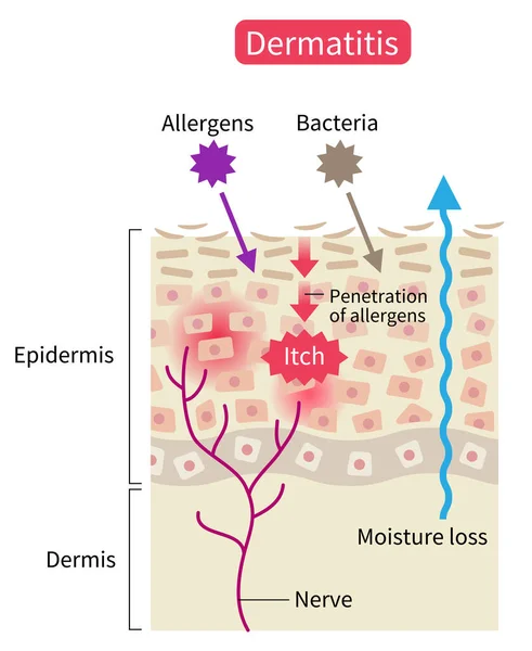 Atopic Dermatitis Eczema Skin Disrupt Moisture Barrier Allows Penetrate External — Stok Vektör