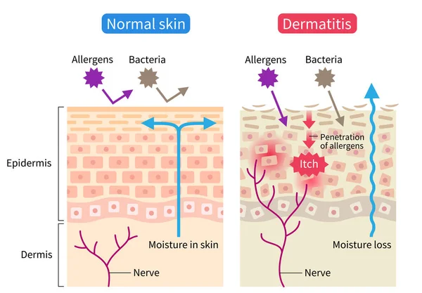 atopic dermatitis (eczema) and normal skin cell illustration. Healthy skin care concept