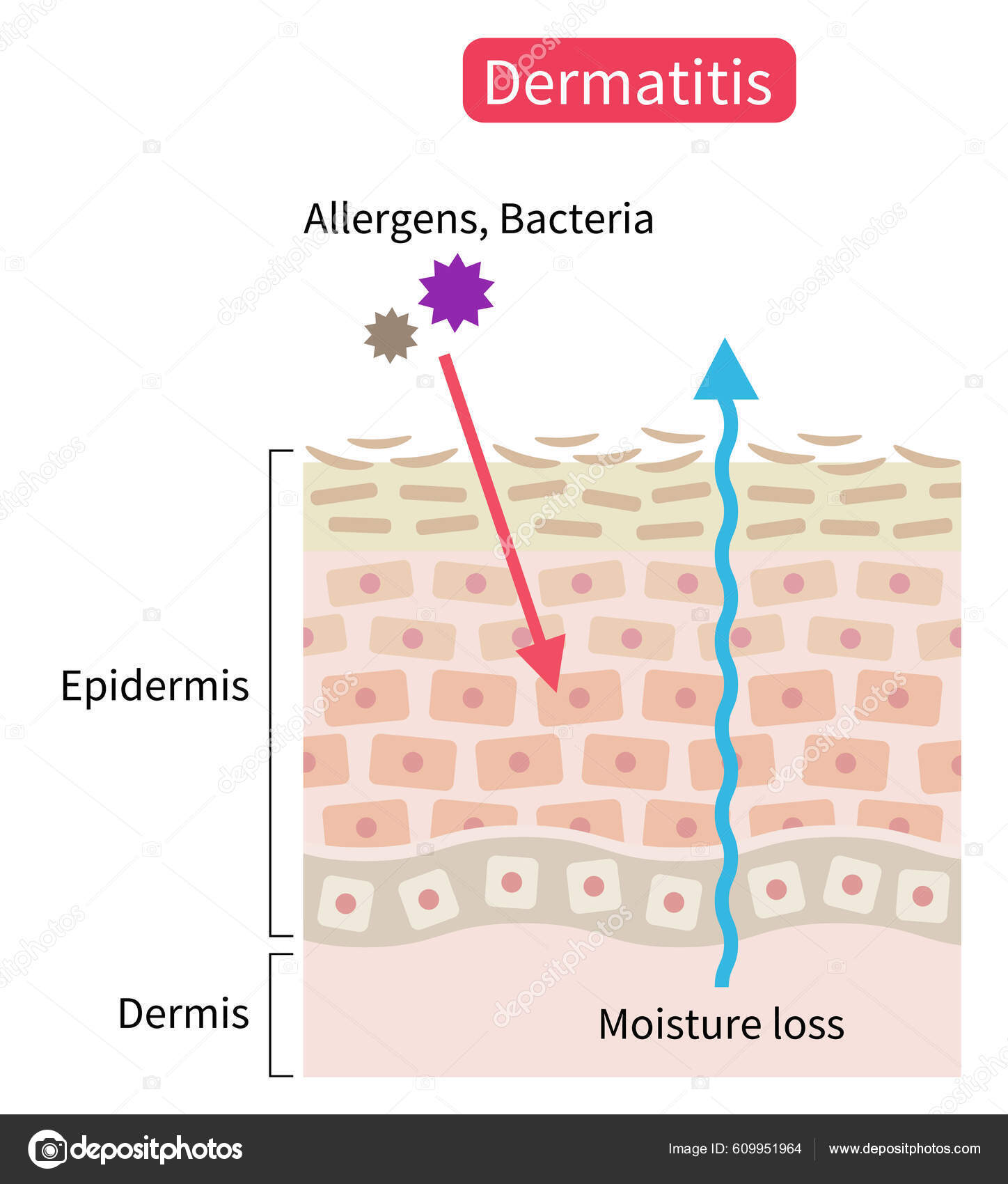 Atopic Dermatitis Eczema Dry Skin Disrupt Moisture Barrier Allows