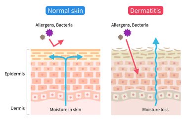 atopic dermatitis (eczema) dry and normal skin cell illustration. Healthy and beauty skin care concept clipart