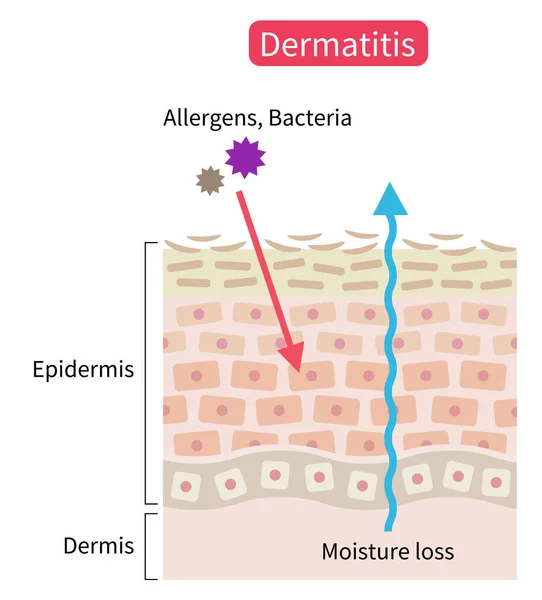 Atopic Dermatitis Eczema Dry Skin Disrupt Moisture Barrier Allows Penetrate — Stock Vector