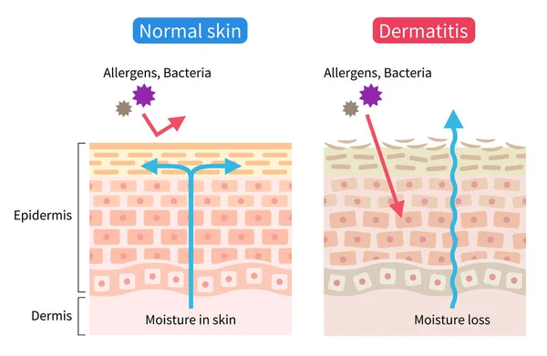 Dermatite Atopica Eczema Illustrazione Cellule Cutanee Secche Normali Concetto Cura — Vettoriale Stock