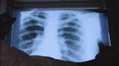 Doktor elinde akciğerlerin röntgenini tutuyor, pencerenin arka planıyla karşılaştırıyor. Akciğer lezyonları.
