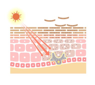 Lekelerin mekanizmasını gösteren illüstrasyon. Gösterim değil..