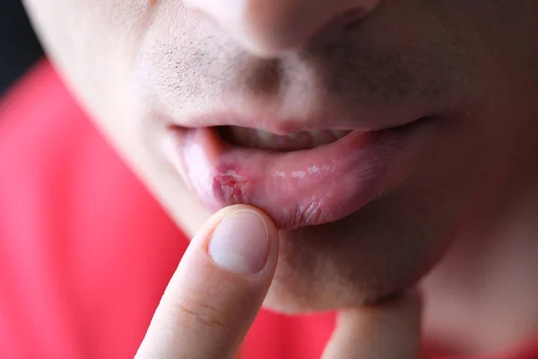 Herpes en el labio interno masculino de cerca. Síntomas y tratamiento del herpes — Foto de Stock