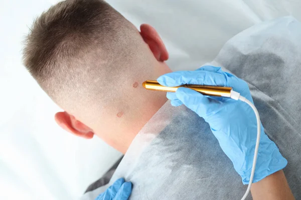 Tracce sul collo maschile dopo la rimozione laser primo piano — Foto Stock