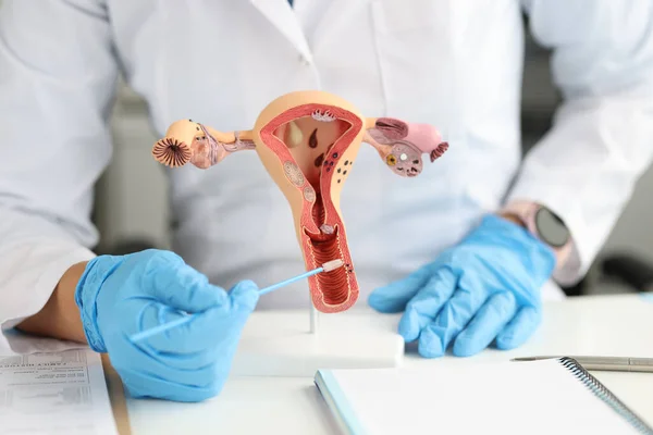 Gynecologist holds urogenital cytobrushes and model of female reproductive system — Stock Photo, Image