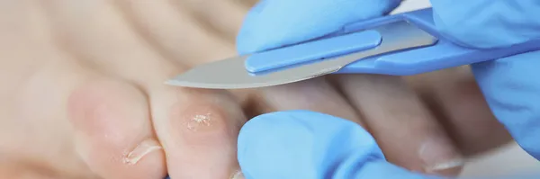 Dokter chirurg in rubber handschoen verwijderen droge callus op de teen met scalpel closeup — Stockfoto