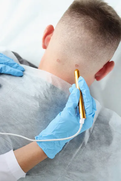 Dokter dermatoloog laser cauterisatie van wrat op man hals — Stockfoto