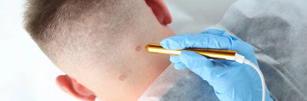Sporen op de mannelijke nek na laserverwijdering close-up — Stockfoto