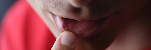 Sul labbro maschile herpes da dentro primo piano — Foto Stock