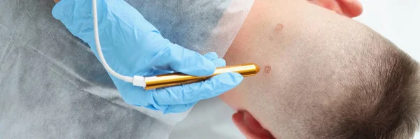 Dokter dermatoloog laser cauterisatie van wrat op man hals — Stockfoto