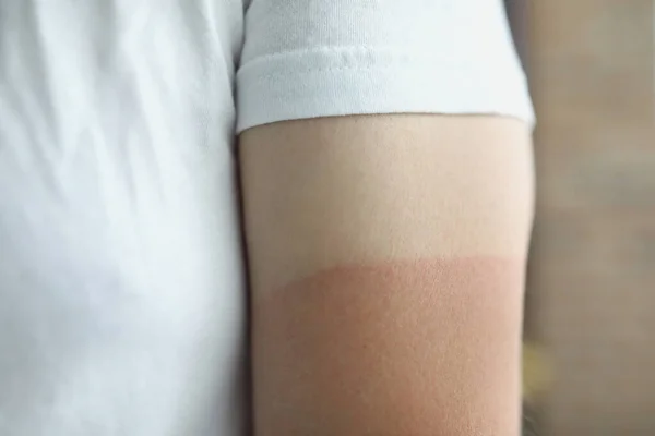 Pele Branca Homem Mão Uma Camiseta Bronzeado Desigual Close Pele — Fotografia de Stock