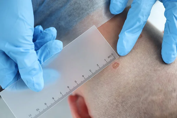 Dermatoloog arts onderzoekt patiënt moedervlek in dermatologie kliniek — Stockfoto