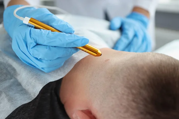 Um médico remove uma verruga de um pescoço de homem, close-up — Fotografia de Stock