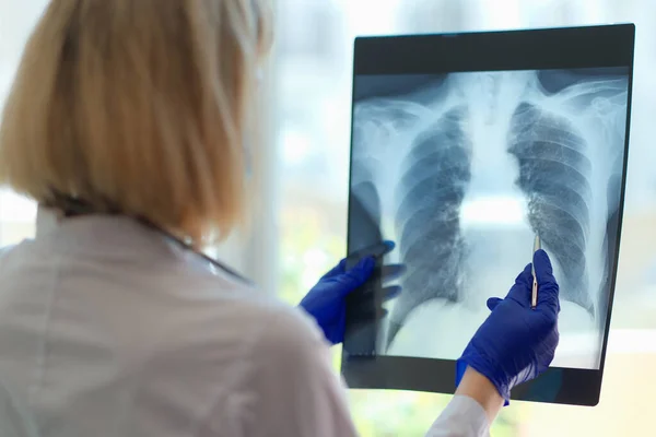 Doktor ukazuje na poškozenou oblast na rentgenu plic — Stock fotografie