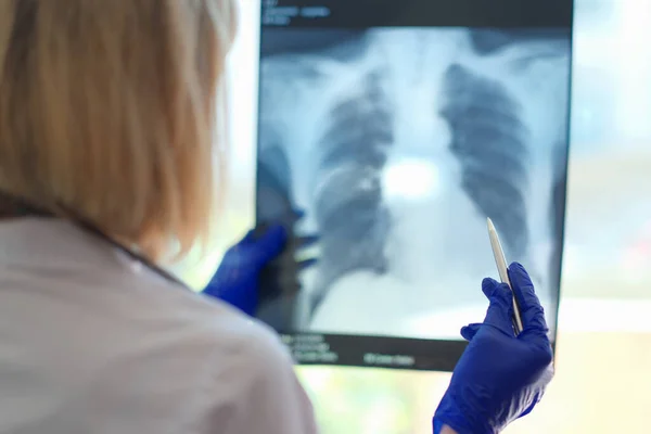 Primer Plano Del Radiólogo Mirando Área Dañada Radiografía Pulmonar Pulmonólogo — Foto de Stock
