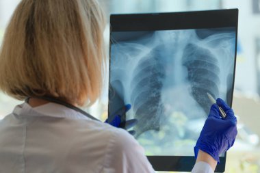 Doktor hastanedeki hastanın göğüs röntgenini inceliyor. Tıbbi resimler konseptinde zatürree ya da bronşit