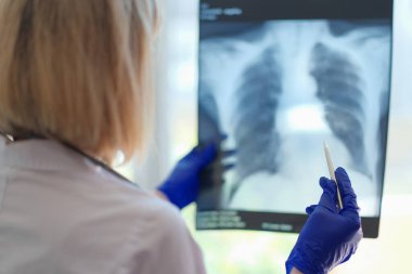 Close-up of female doctor pulmonologist holding x-ray photograph of lungs in hands. Radiologist making diagnostic of patient. Medicine and checkup concept
