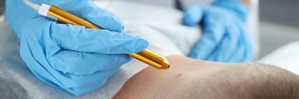 Een Dermatoloog Verwijdert Een Papilloom Uit Een Mensennek Close Lasermolverwijdering — Stockfoto