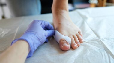 Top view of doctor orthopedist applying brace for hallux valgus for patient. Deformity of joints of foot and healthcare concept