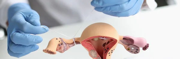 Doctor Gynecologist Ligates Fallopian Tubes Example Layout Female Reproductive System — Stock Photo, Image
