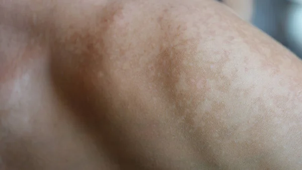 Skin care problem spots on shoulder skin and health concept. Melasma pigment spots dry skin