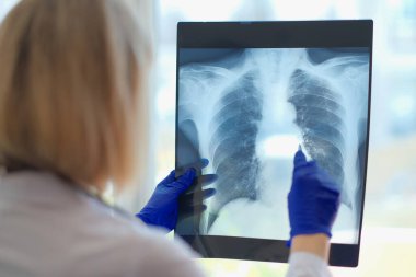 Doktor röntgen cihazını hastanede tutuyor. Zatürree covid-19 ve bronşit teşhisi