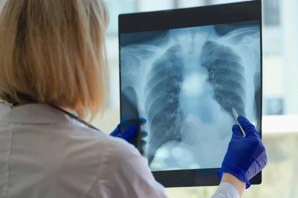 Primer Plano Del Médico Neumólogo Que Mira Radiografía Los Pulmones — Foto de Stock