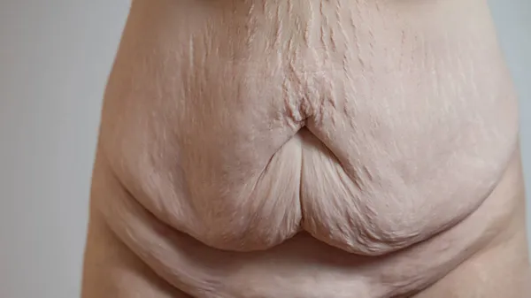 Saggy skin after loosing serious weight on belly or abdomen area of a body. Visible flabby skin on tummy and around bellybutton.