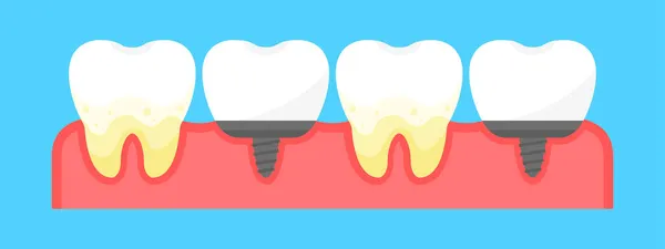 Μια Σειρά Από Δόντια Πλάκας Και Οδοντικά Εμφυτεύματα Οδοντιατρική Δόντια — Φωτογραφία Αρχείου