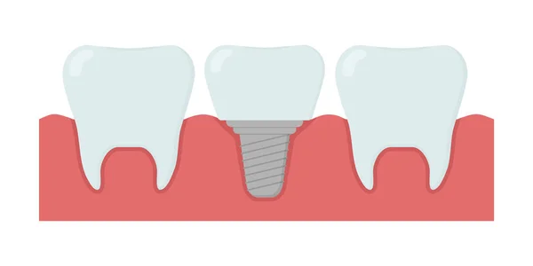 Cartoon Gezonde Tanden Tandheelkundig Implantaat Model Voor Stomatologie Tandheelkunde Geïsoleerde — Stockvector
