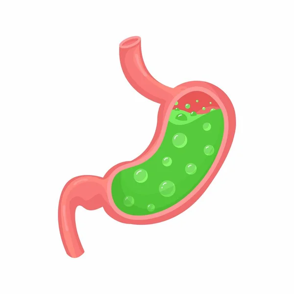 胃内的矢量医学图解 恶心的胃胃炎和酸液倒流 消化不良 胃灼热和胃痛 — 图库矢量图片