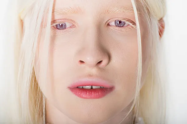 Porträtt Ung Albino Kvinna Tittar Bort Isolerad Vitt — Stockfoto