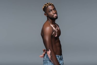 shirtless african american man with vitiligo looking at camera while posing in jeans isolated on grey