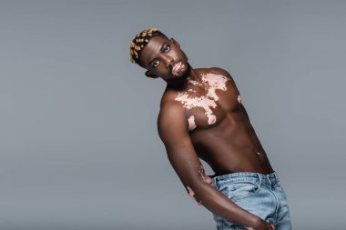 young and shirtless african american man with vitiligo skin and trendy hairstyle posing isolated on grey