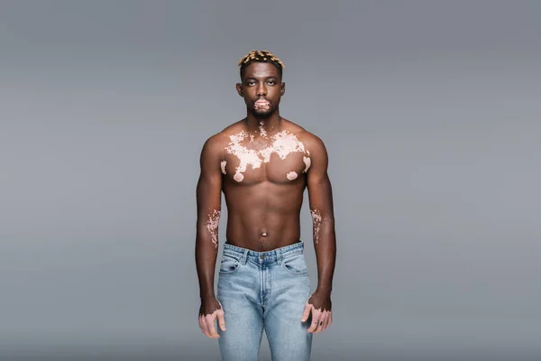 Shirtless Muscular African American Man Vitiligo Skin Looking Camera Isolated — Fotografia de Stock