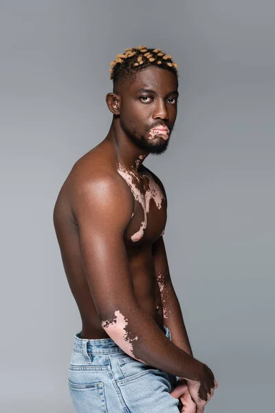 Shirtless African American Man Vitiligo Skin Trendy Hairstyle Looking Camera — Stockfoto
