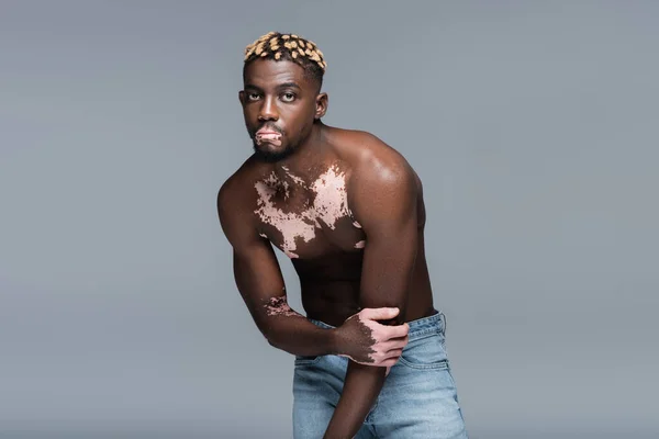 Shirtless African American Man Vitiligo Skin Trendy Hairstyle Posing Isolated — Stockfoto