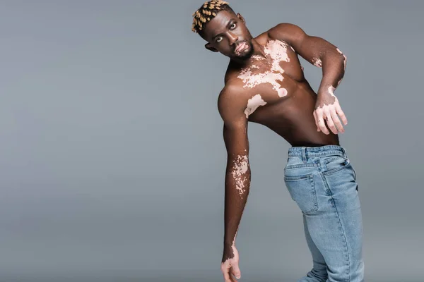 Young African American Man Vitiligo Skin Muscular Torso Trendy Hairstyle — 图库照片