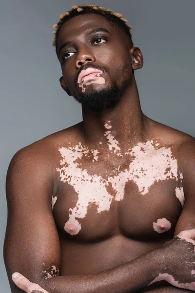 Shirtless African American Man Vitiligo Skin Crossed Arms Looking Away — Photo