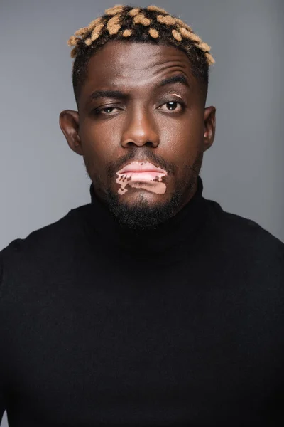 Hombre afroamericano reflexivo con piel de vitiligo mirando cámara aislada en gris - foto de stock